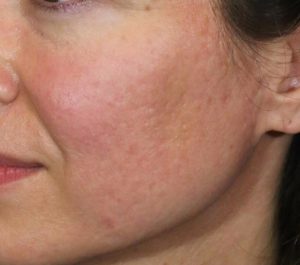 Before Sofwave acne scars treatment by Dr. Anne Chapas
