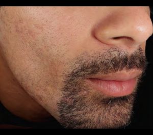 Before Sofwave acne scars treatment by Dr. David Goldberg