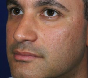 Before Sofwave acne scars treatment by Dr. Anne Chapas