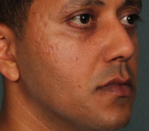 Before Sofwave acne scars treatment by Dr. Arielle Kauvar