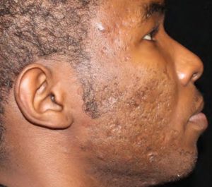 Before Sofwave acne scars treatment by Dr. David Goldberg