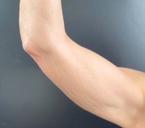 Before Sofwave arms treatment at Aestheticare Medspa