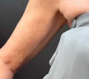 Before Sofwave arms treatment at GreatSkin Aestheticare