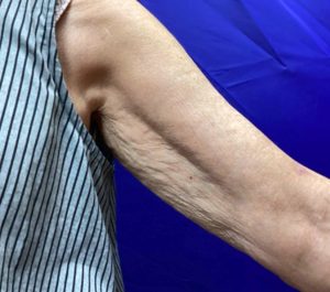 Before Sofwave arms treatment by Adean Kingston