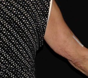 Before Sofwave arms treatment by Amy Taub