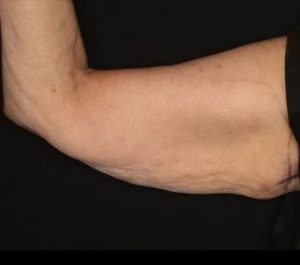 Before Sofwave arms treatment by Dr. Roy Geronemus