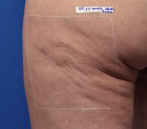 Before Sofwave cellulite procedure by Dr. Girish Munavalli