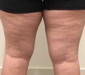 Before Sofwave cellulite treatment at GreatSkin Inc