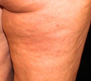 Before Sofwave cellulite treatment by Dr. David Goldberg