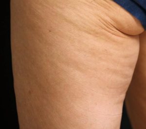 Before Sofwave cellulite treatment by Dr. Eric Bernstein