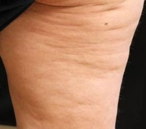 Before Sofwave cellulite treatment by Dr. Suzanne Kilmer