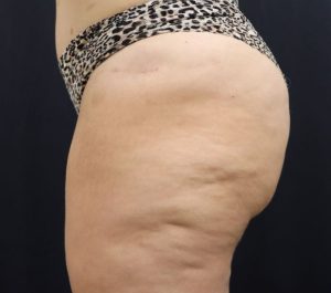 Before Sofwave cellulite treatment by Whitfield