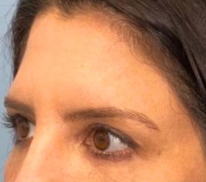 Before Sofwave eyes treatment by Dr. Jason Bloom