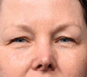 Before Sofwave eyes treatment by Dr. Girish Munavalli