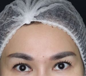 Before Sofwave eyes treatment at Evitderma Clinic