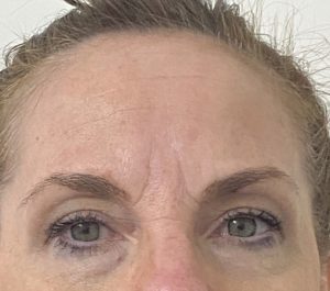 Before Sofwave eyes treatment at Malibu Aesthetics