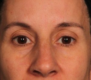 Before Sofwave eyes treatment by Dr. Arielle Kauvar