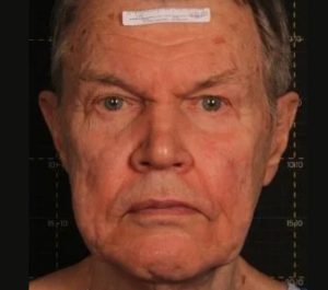 Before Sofwave face treatment by Dr. Roy Geronemus