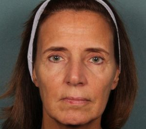 Before Sofwave face treatment by Dr. Roy Geronemus