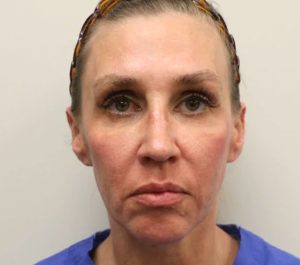 Before Sofwave face treatment at Ava MD