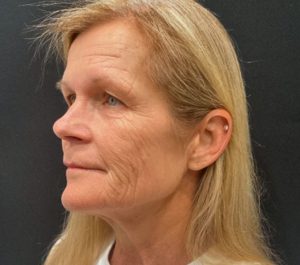 Before Sofwave face treatment at JW's Day Spa