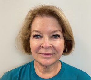 Before Sofwave face treatment at Skinzone Rx