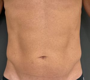 Before Sofwave male abdominal front view treatment by Virginia Benitez Roig MD