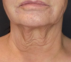Before Sofwave neck procedure at Smile & Skin Aesthetics