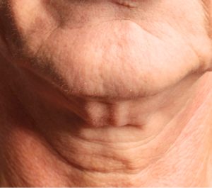 Before Sofwave neck procedure at Glistening Beauty Sarah O'Donnell