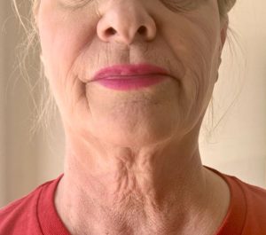 Before Sofwave neck procedure at Skintellect