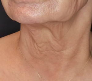 Before Sofwave neck procedure at Smile & Skin Aesthetics