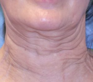 Before Sofwave neck procedure by Craig Colville – Bella Vista