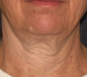 Before Sofwave neck procedure by Suzanne Kilmer