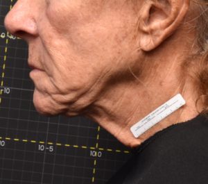 Before Sofwave submental procedure by Dr. Munavalli