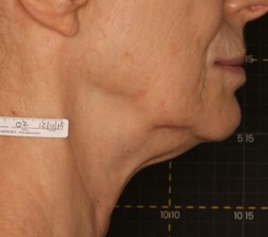 Before Sofwave submental procedure by Dr. Roy Geronemus