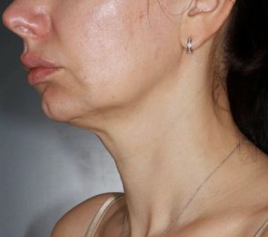 Before Sofwave submental procedure at Dermatology Circle PLLC