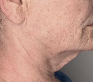 Before Sofwave submental procedure at Forever Young