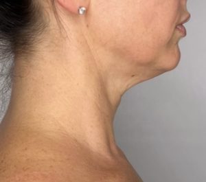 Before Sofwave submental procedure at Laurel Corinne Medspa