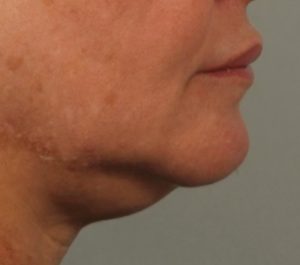 Before Sofwave submental procedure at SKIN I.D Aesthetics