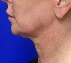 Before Sofwave submental procedure by Adean Kingston