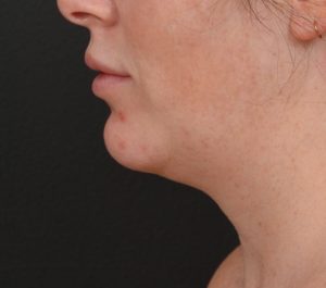 Before Sofwave submental procedure by Sue Ellen Cox