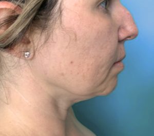 Before Sofwave submental treatment by Weldy Tina