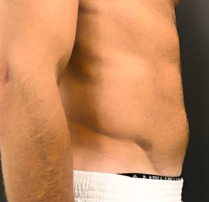 After 6 sessions Sofwave male 1 abdominal treatment by Virginia Benitez Roig MD