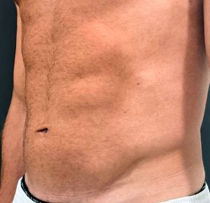 After 6 sessions Sofwave male abdominal treatment by Virginia Benitez Roig MD