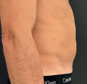 Before Sofwave male 1 abdominal treatment by Virginia Benitez Roig MD