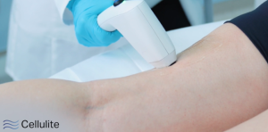 Sofwave Cellulite Treatment