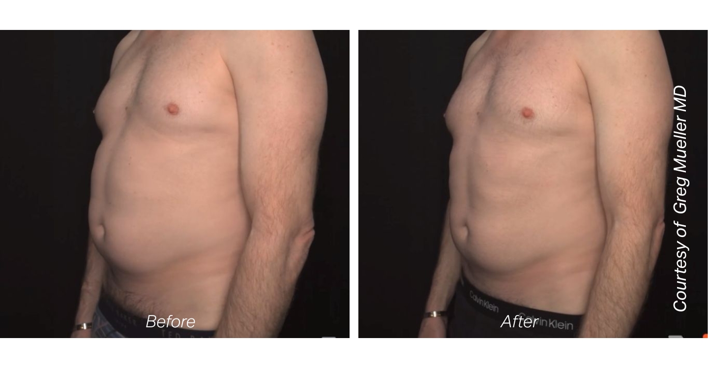 before-and-after-pure-impact-treatment