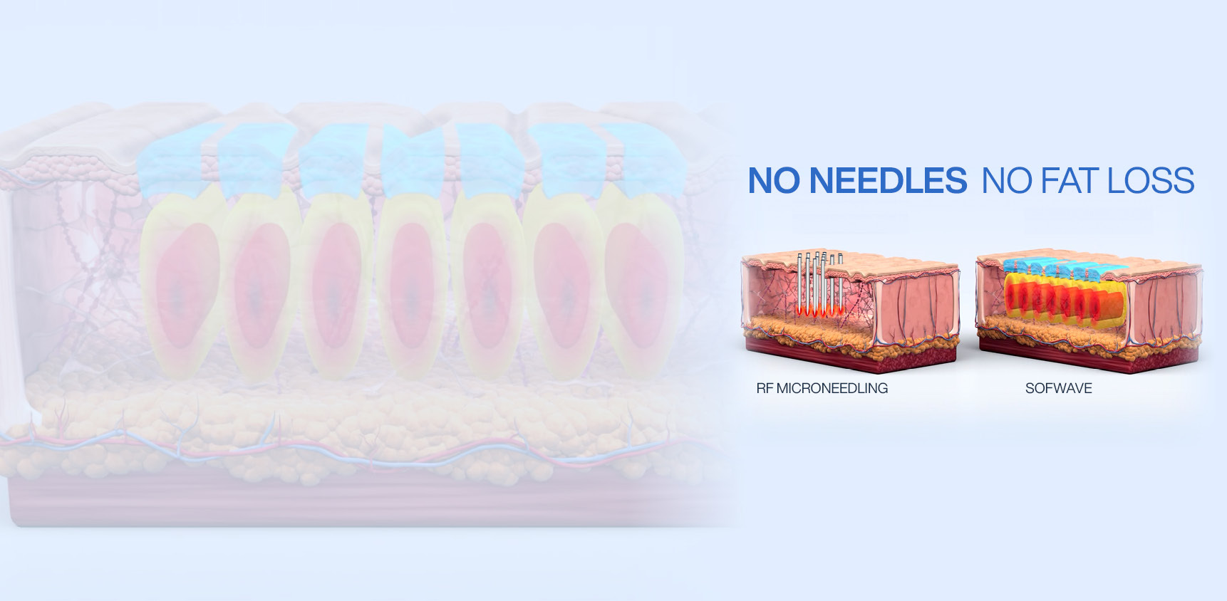 Trade in Your RF Microneedling Device for the Needle-Free Power of Sofwave™ - comperrison