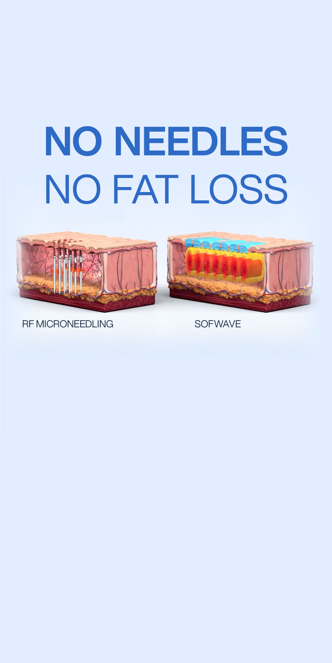 Trade in Your RF Microneedling Device for the Needle-Free Power of Sofwave™ - comperrison