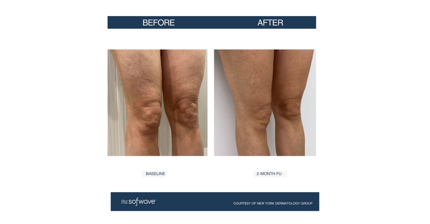 Sofwave cellulite appearance treatment - before and after white